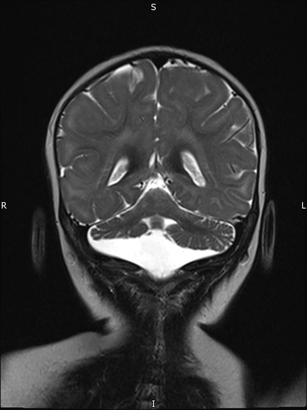 Coronal-view MRI of a patient with a CASK mutation