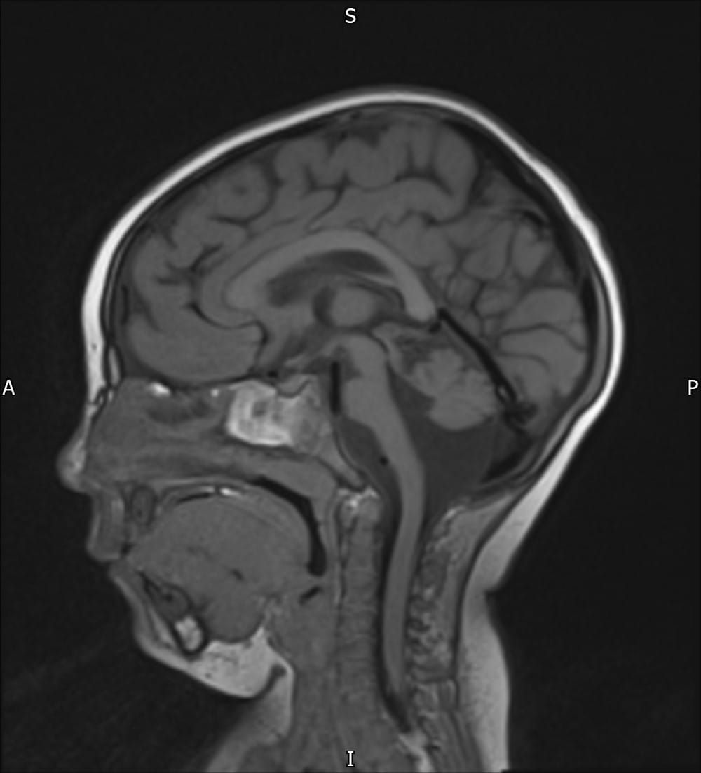 Side-view MRI scan of a patient with a CASK mutation showing MICPCH features